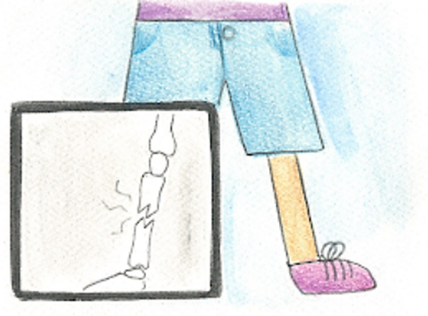 Broken bones story preview